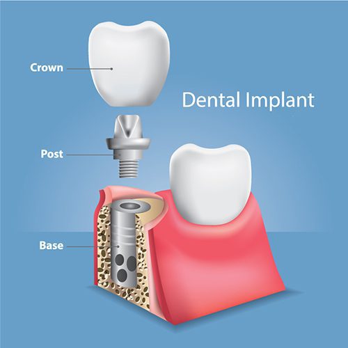 Best Dental Insurance Plans for Implants of 2022