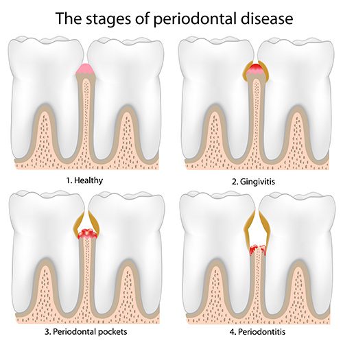 Peroidontal