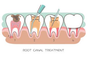 root canal treatment steps