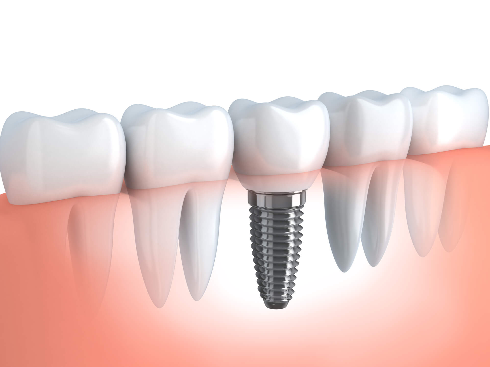 where can i get dental implants in fort pierce fl?