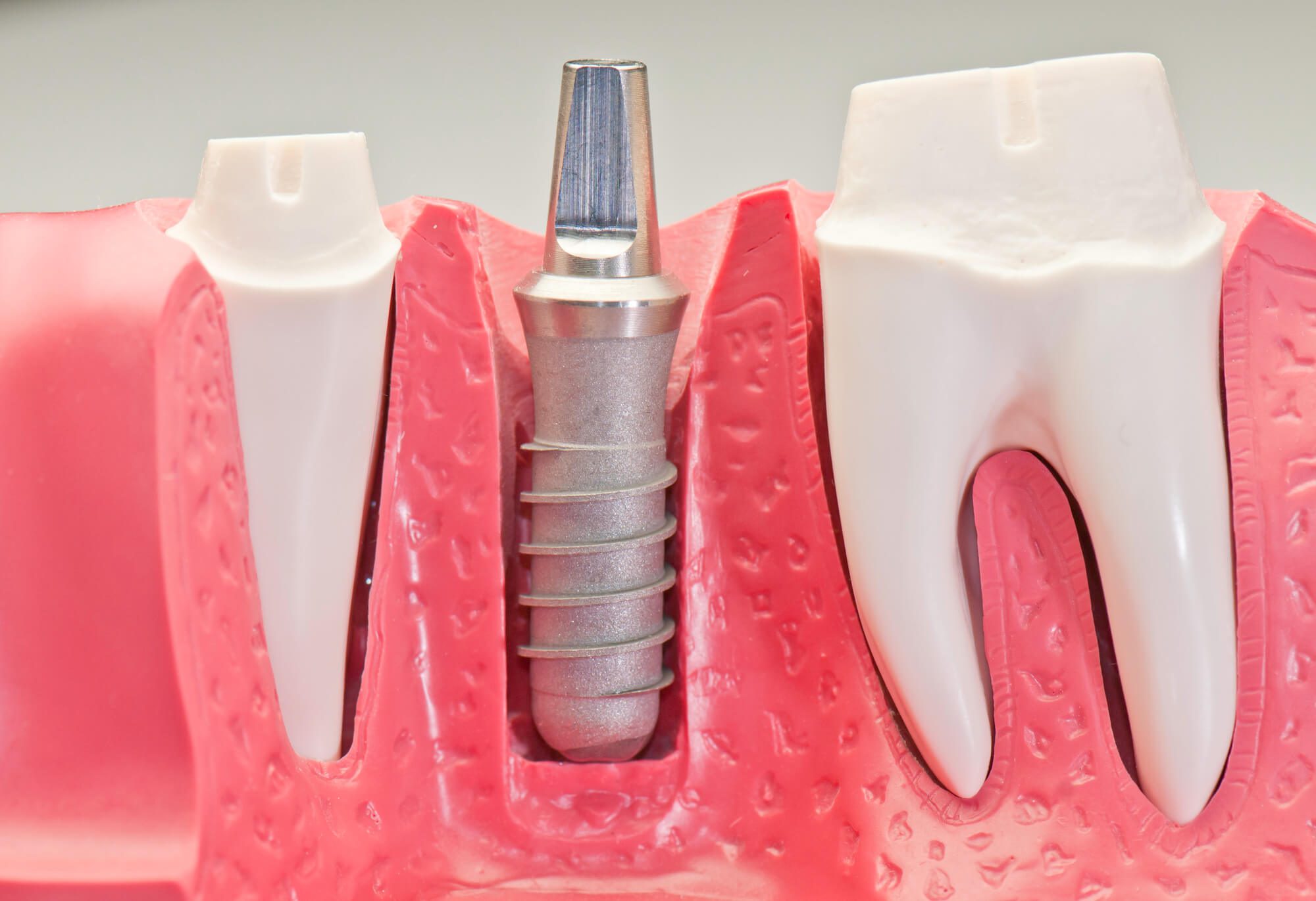 where can i get dental implants in fort pierce fl?