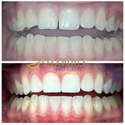 invisalign before and after 2"