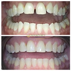 invisalign before and after 1"