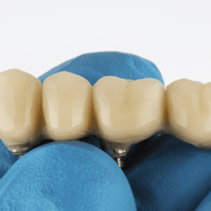 dental bridges 101: types, benefits, care, and more