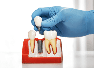 top benefits of dental implants