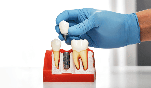 top benefits of dental implants
