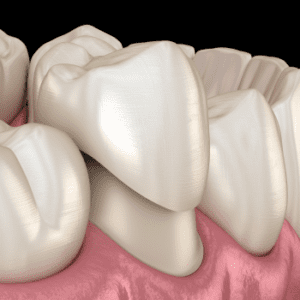 types of dental crowns
