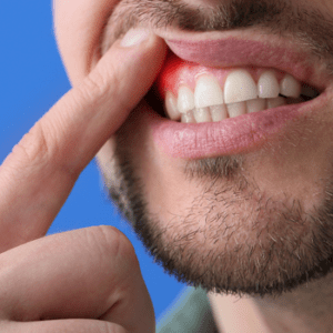 periodontal disease causes