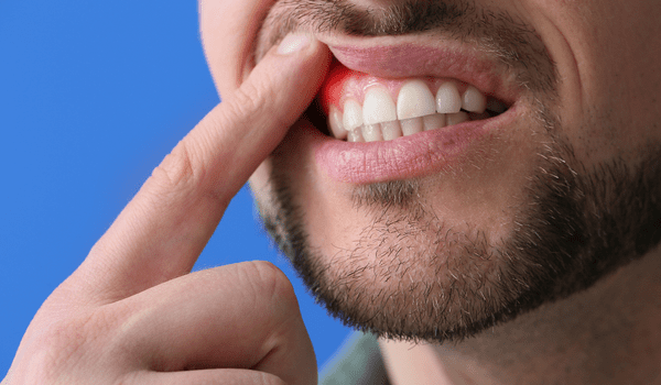periodontal disease causes